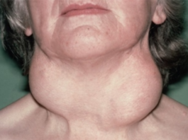 Ārsti nekad tev to neteiks, bet Ikvienam ir vairogdziedzera problēmas : Lūk, kā jūs varat izārstēt to dabīgā ceļā!