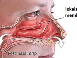 Joprojām moka drausmīgas iesnas un netiec no tām vaļā? Uzzini kā attīrīt deguna blakusdobumu tikai vienas dienas laikā!