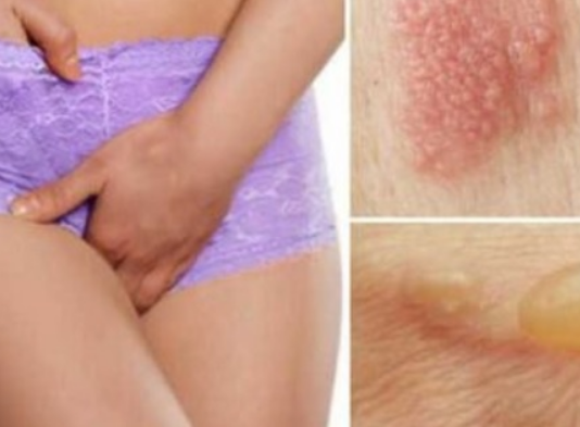 Ko darīt ja uz savām ģenitālijām redzi tulznas vai čūlas? Nekrīti panikā, šeit ir pamācība, kas nekavējoties jādara!