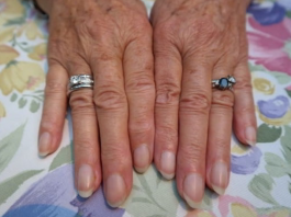 Vecā kundzīte palūdza, lai viņai apgrieztu rokas nagu, taču lūk, ko viņai atbildēja medmāsa