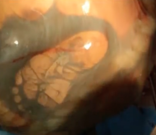 Mamma vien 41. grūtniecības nedēļā pirmo reizi aizgāja pie ginekologa! Pēc ultrasonogrāfijas ārsti šausmās saķēra galvu!