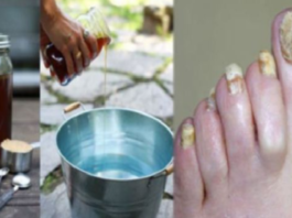 Vienkārša recepte kā uz visu mūžu atbrīvoties no pretīgās un traucējošās kāju sēnītes!