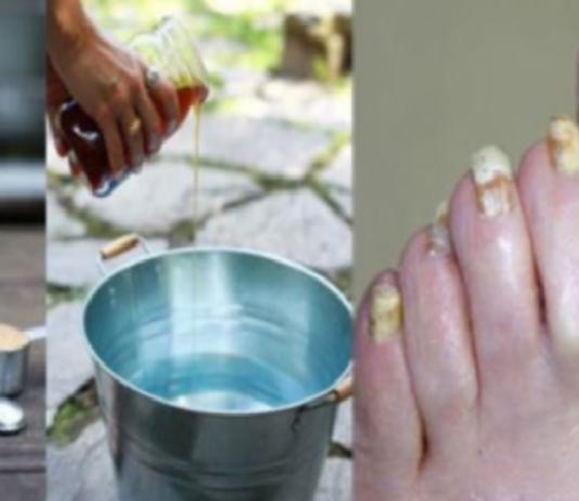 Vienkārša recepte kā uz visu mūžu atbrīvoties no pretīgās un traucējošās kāju sēnītes!