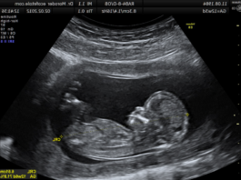 Pāris veica 4D Ultraskaņas pārbaudi mazulim un uzreiz to nožēloja! Lūk, kādēļ nevajag steigties!