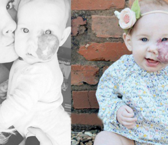 Meitiņa piedzima ar lielu dzimumzīmi uz sejas. Lūk, ko izdarīja māta, lai sargātu savu bērnu